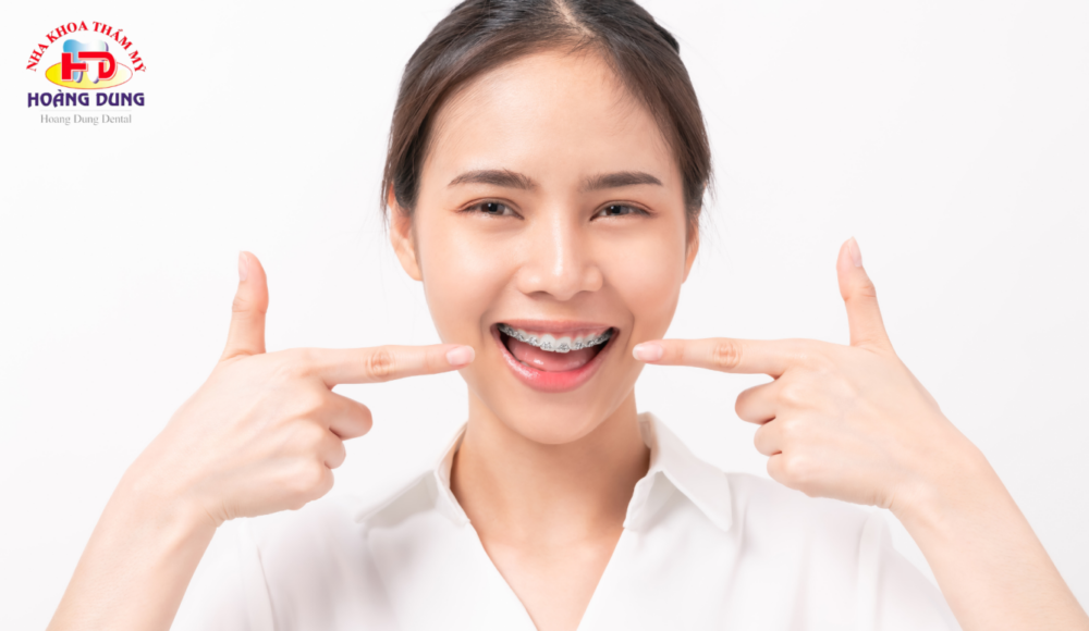 Những Điều Nên Biết Về Niềng Răng Mắc Cài