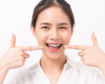 Những Điều Nên Biết Về Niềng Răng Mắc Cài