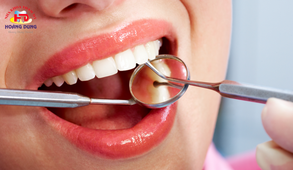 Mòn cổ chân răng là gì? Nguyên nhân và cách điều trị