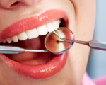 Mòn cổ chân răng là gì? Nguyên nhân và cách điều trị