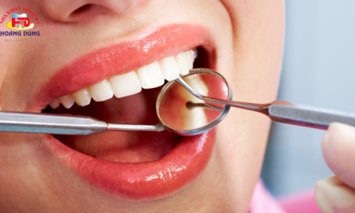 Mòn cổ chân răng là gì? Nguyên nhân và cách điều trị